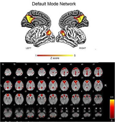 Functional Brain Connectivity in Mild Cognitive Impairment With Sleep Disorders: A Study Based on Resting-State Functional Magnetic Resonance Imaging